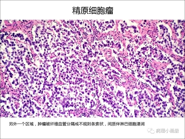 泌尿病理--精原细胞瘤VS精母细胞瘤