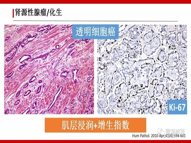 泌尿课程/尿路腺样病变的诊断要点