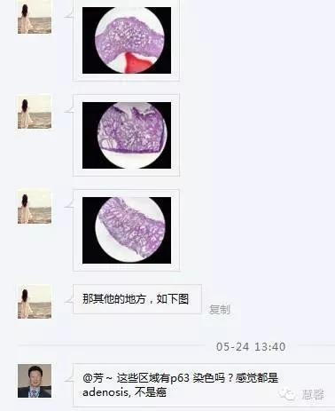 前列腺腺癌？（芳分享病例，华夏泌尿群讨论，孔祥田老师讲解）