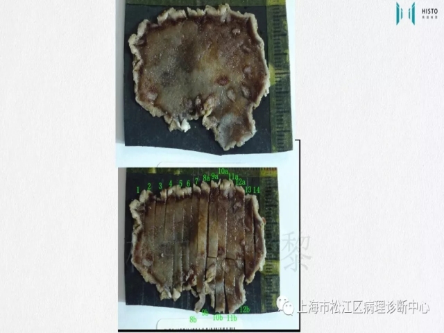 上消化道早癌病理诊断中的困惑及基本对策回顾