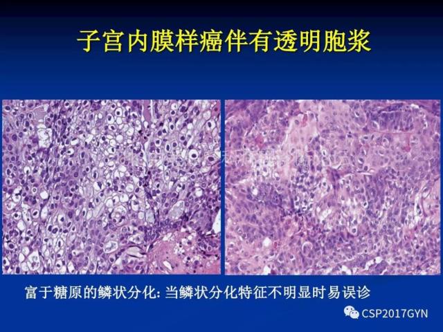 子宫内膜癌：诊断与进展