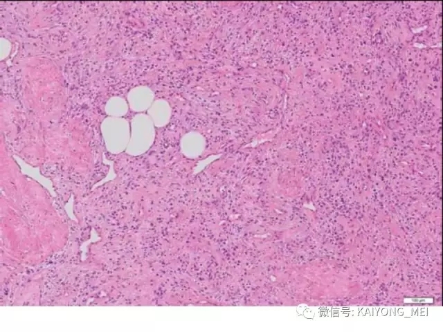 女性生殖道软组织肿瘤病理诊断及进展（一）