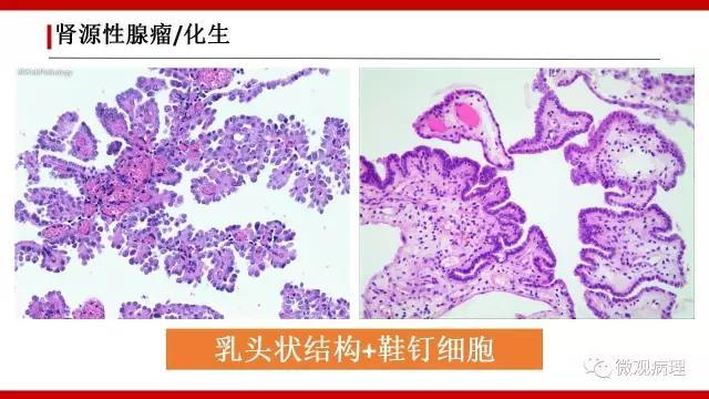 泌尿课程/尿路腺样病变的诊断要点