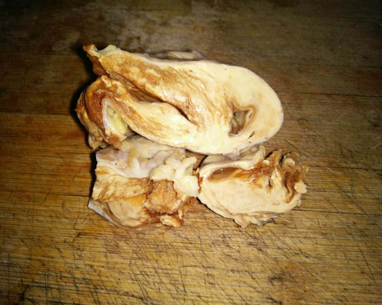 病理科工作札记（四十四）绒毛色素结节性滑膜炎？