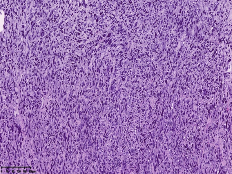 子宫平滑肌肉瘤? 子宫平滑肌肉瘤?