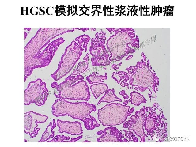 中华病理学会基层培训遵义站讲座（一）——卵巢和输卵管浆液性肿瘤的诊断和鉴别诊断