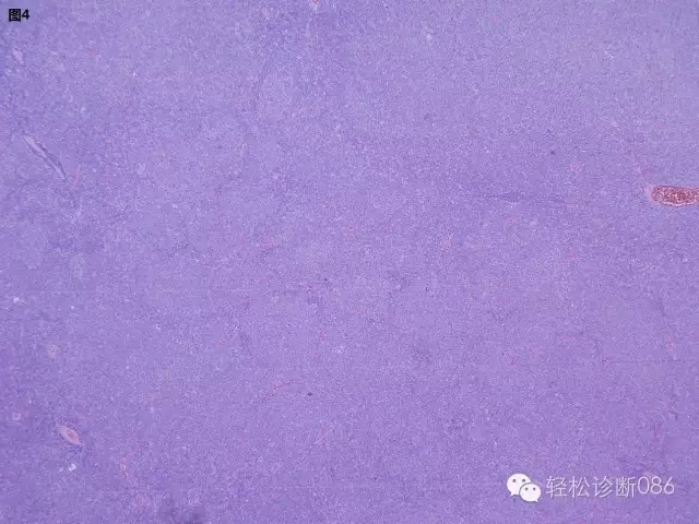 小B细胞非霍奇金淋巴瘤——慢性淋巴细胞白血病（1）