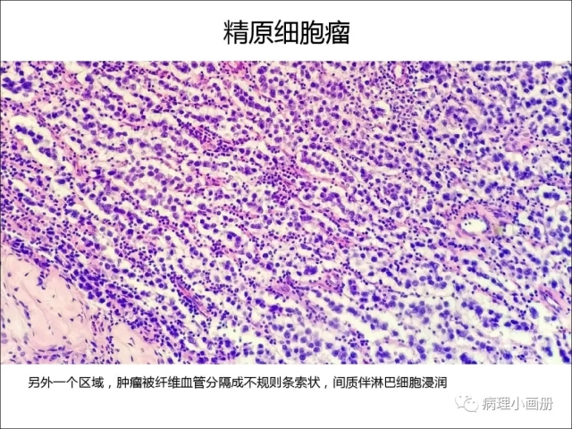 泌尿病理--精原细胞瘤VS精母细胞瘤
