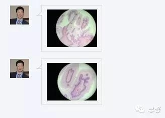 阴道鳞状上皮乳头状瘤？尖锐湿疣？（孔祥田老师病例分享，粉蓝医疗科技（杭州）有限公司女性生殖2群讨论，孔祥田(Max)*Roswell*老师讲解）