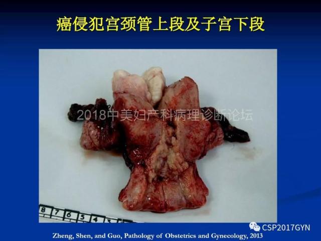 子宫内膜癌：诊断与进展