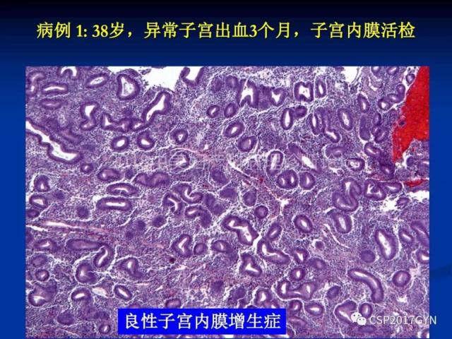 子宫内膜癌：诊断与进展