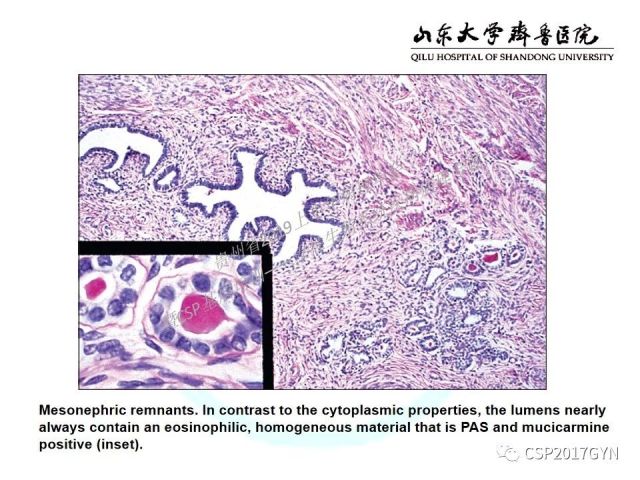 中华病理学会基层培训遵义站讲座（四）——宫颈腺癌的诊断及新分型