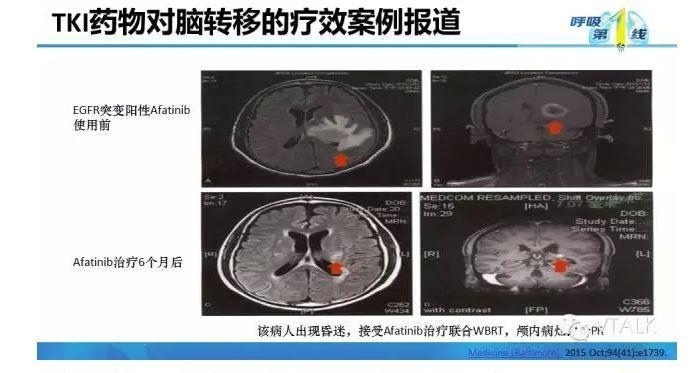 驱动基因阳性NSCLC脑转移：阿克琉斯之踵？