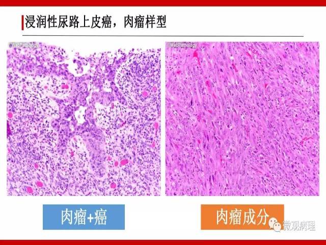 泌尿课程/浸润性尿路上皮癌病理学类型