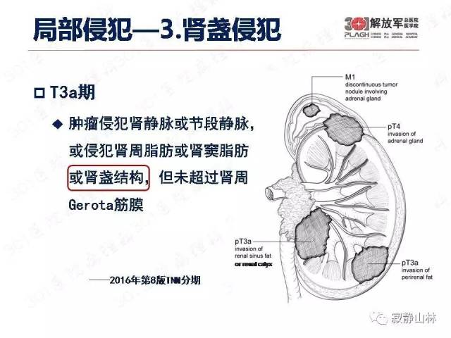 泌尿系统常见肿瘤标本病理报告规范
