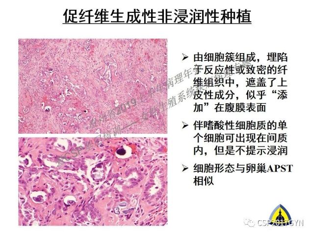 中华病理学会基层培训遵义站讲座（一）——卵巢和输卵管浆液性肿瘤的诊断和鉴别诊断