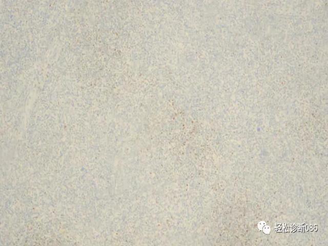滤泡辅助T细胞（TFH）及其相关淋巴瘤（13）