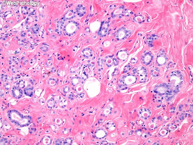 乳腺病理-乳腺良性增生-微腺性腺病 04
