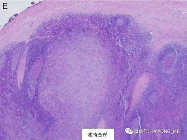 T细胞淋巴瘤病理诊断及进展（一）