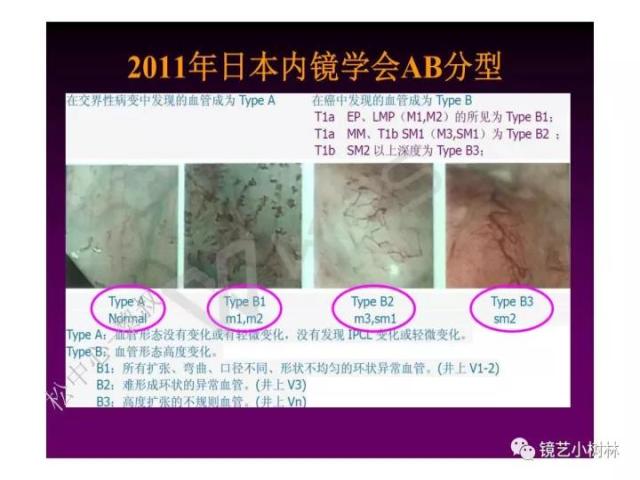 上消化道早癌病理的学习心得体会（附胃牵手癌的病例特点文献学习）