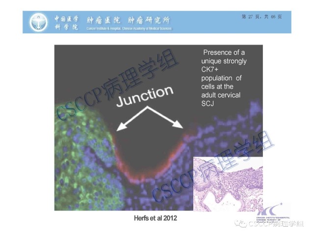 宫颈癌前病变中的诊断难点及阴道镜中ECC的 应用价值
