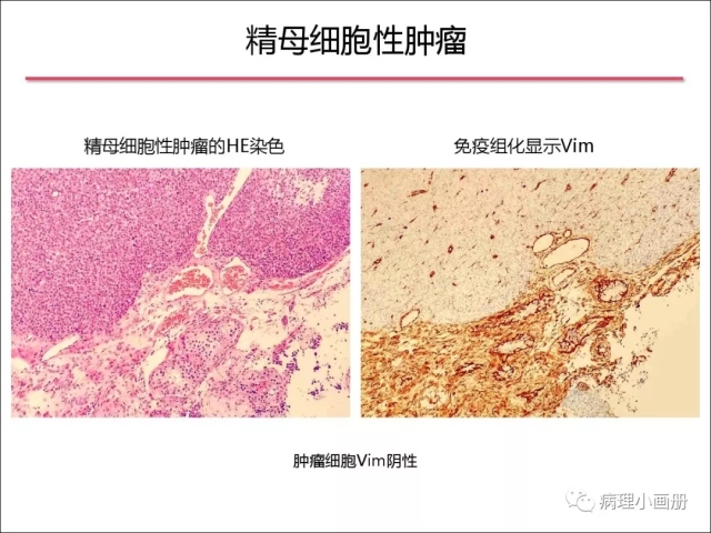 泌尿病理--精原细胞瘤VS精母细胞瘤
