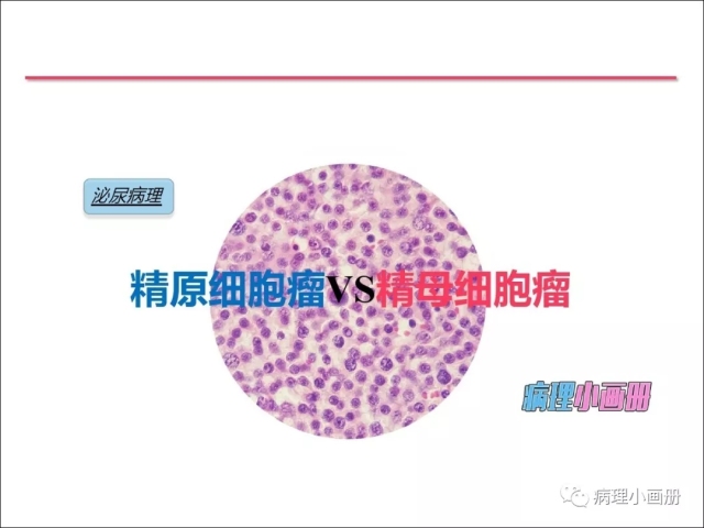 泌尿病理--精原细胞瘤VS精母细胞瘤