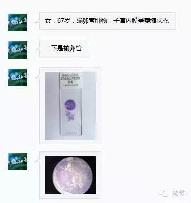 输卵管浆液性癌（张杰分享，孔祥田(Max)*Roswell*老师讲解）