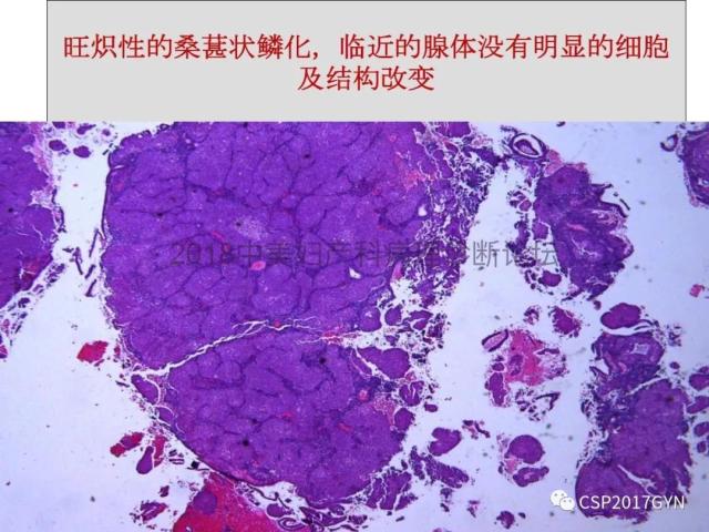 子宫内膜假肿瘤性病变及类似癌样病变
