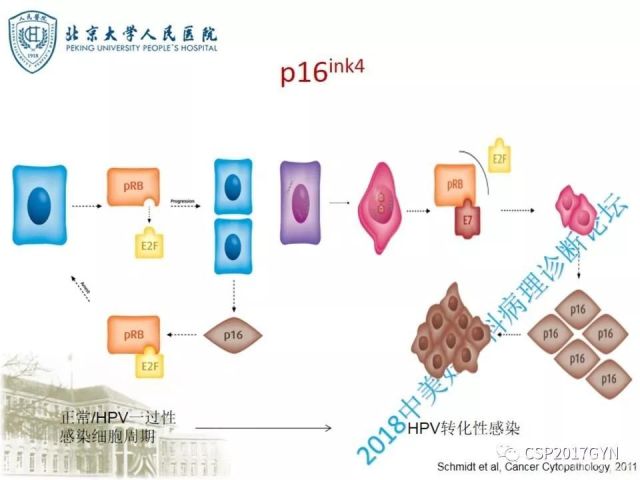 宫颈鳞状上皮内病变病理诊断中问题