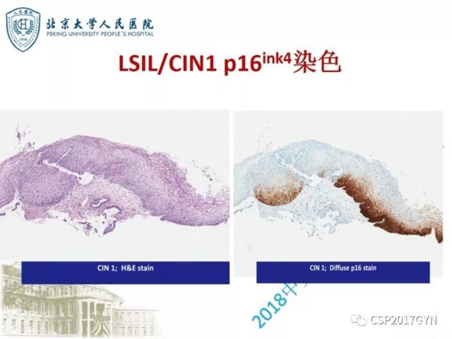 宫颈鳞状上皮内病变病理诊断中问题