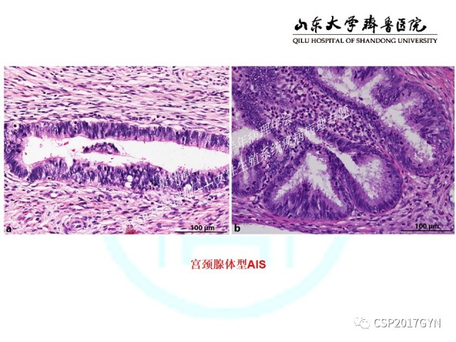 中华病理学会基层培训遵义站讲座（四）——宫颈腺癌的诊断及新分型