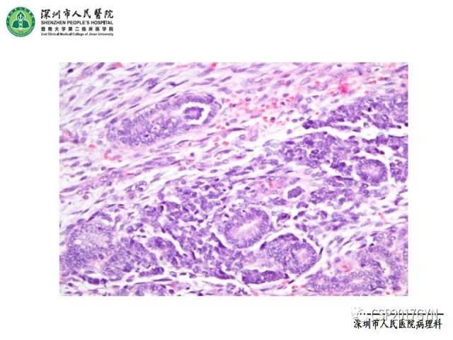 2019USCAP妇科病理热点介绍