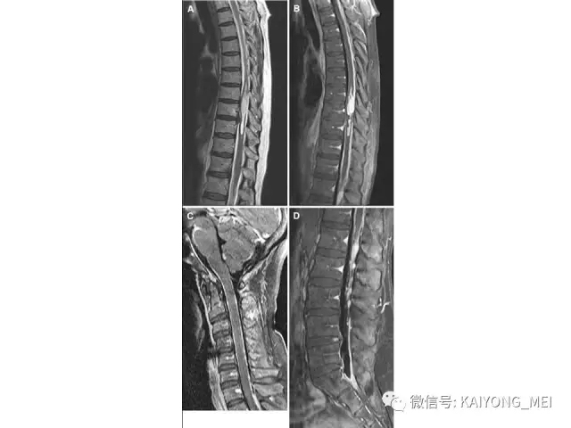 2016 WHO中枢神经系统肿瘤分类解读（三）
