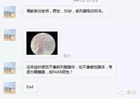 前列腺电切标本出现的非前列腺、非精囊腺组织是什么？原因何在？（张睿病例分享，孔祥田(Max)*Roswell*NM老师讲解）