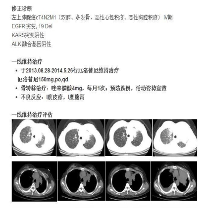 中日韩个体化诊疗案例大赛经典赏析之十三——组织活检突变阴性，血液检测EGFR19DEL,TKI 治疗PFS9个月