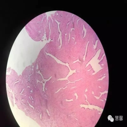 子宫腺肉瘤【吴梅娟】分享；【刘从容】老师讲解）