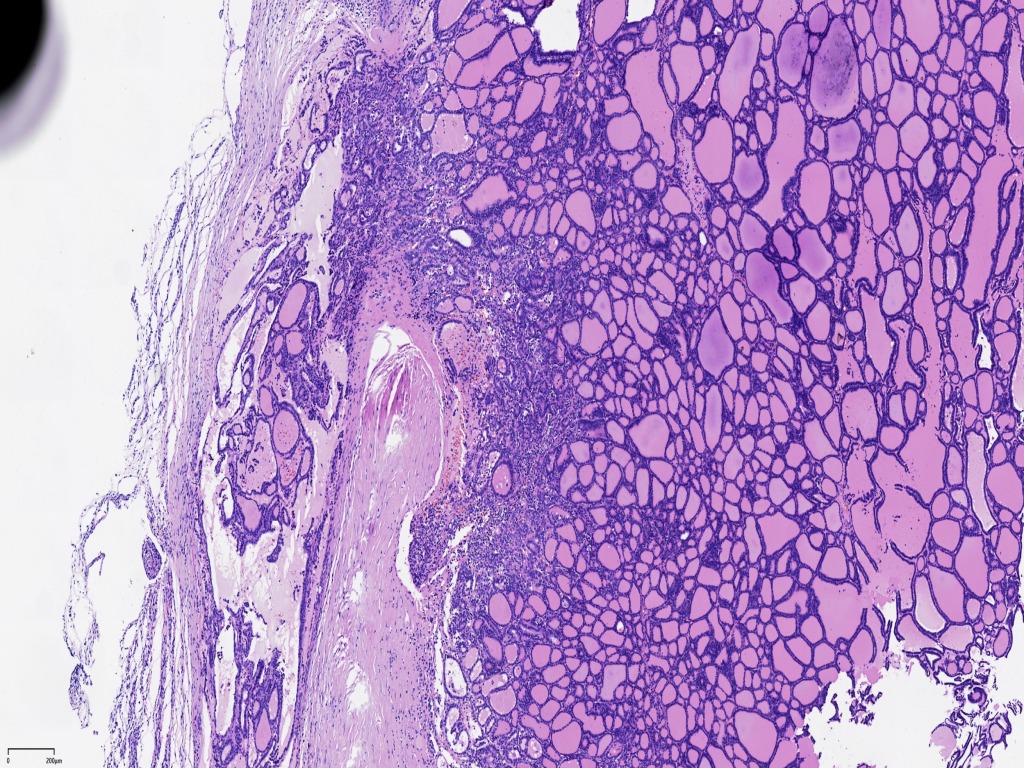 甲状腺滤泡癌19岁（101）