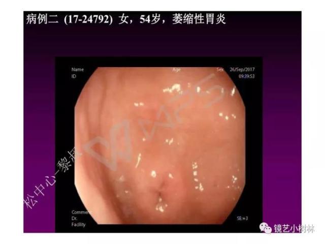 上消化道早癌病理的学习心得体会（附胃牵手癌的病例特点文献学习）