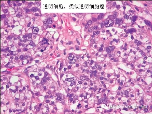 卵巢癌的病理诊断新进展（一）