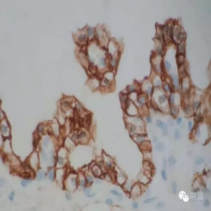 透明细胞乳头状肾细胞癌？TFE3 Traslocation Carcinoma？（赵洋分享，孔祥田(Max)*NM老师讲解）
