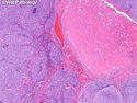 乳腺病理-乳腺癌-乳腺癌分子分型