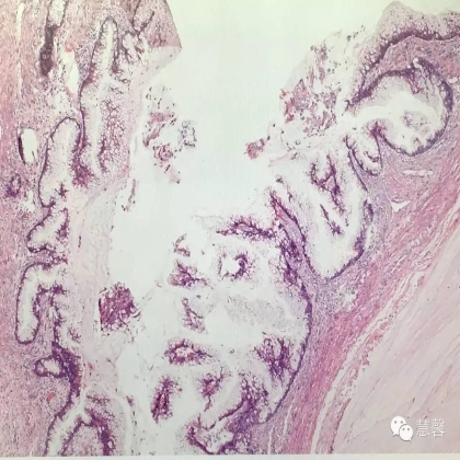 低级别黏液性肿瘤转移到卵巢伴腹腔假黏液瘤形成【小车】分享；【刘从容】老师讲解