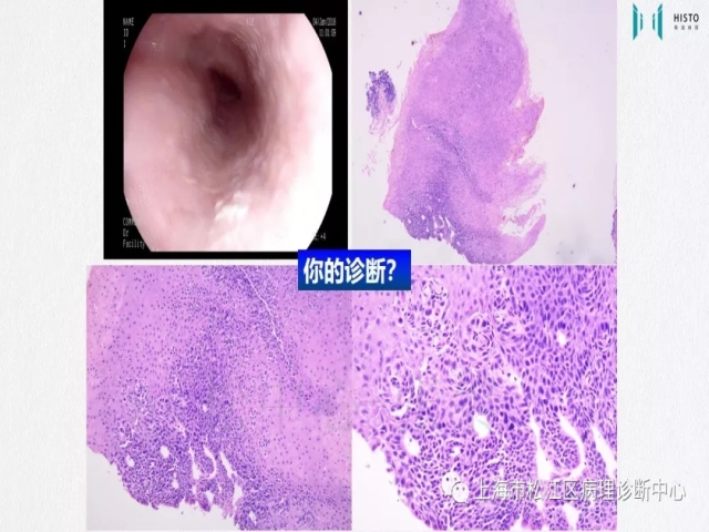 上消化道早癌病理诊断中的困惑及基本对策回顾
