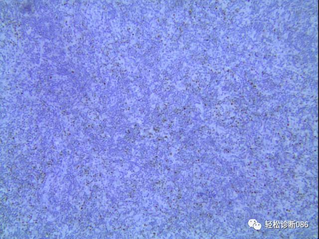 滤泡辅助T细胞（TFH）及其相关淋巴瘤（11）