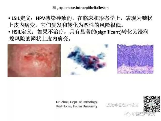 独家专访国内妇产科病理大咖周先荣教授：子宫颈上皮内病变及相关临床情况的若干病理学问题（一）
