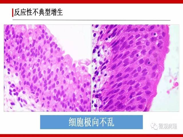 泌尿课程/非浸润性尿路上皮病变诊断的一些困惑