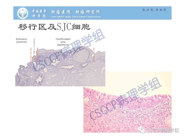 宫颈癌前病变中的诊断难点及阴道镜中ECC的 应用价值