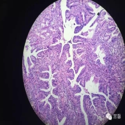 宫颈绒毛状腺癌诊断及相关问题（沈苗分享病例，刘从容老师讲解）