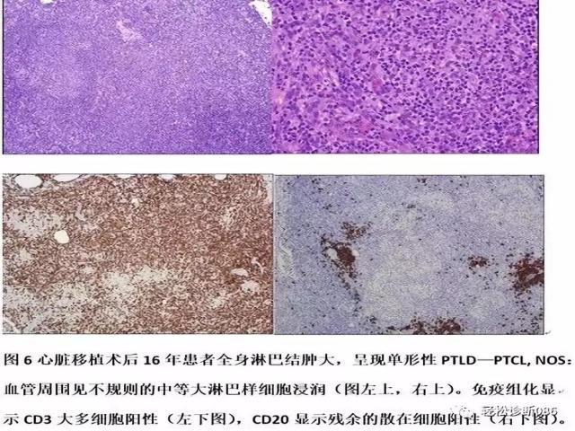 免疫缺陷相关性淋巴组织增殖性疾病（7）